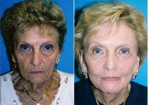 Skin Resurfacing Before & After Gallery - Patient 122406681 - Image 1