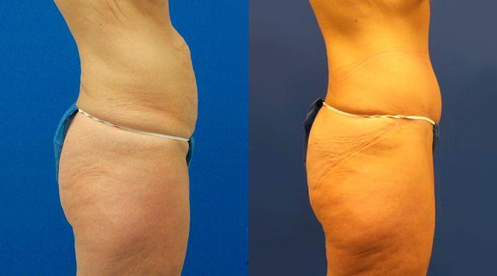 Hidden Tummy Tuck Before & After Gallery - Patient 325128 - Image 2