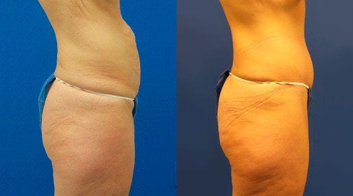 Tummy Tuck Before & After Gallery - Patient 122406680 - Image 2