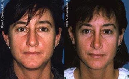 Rhinoplasty Before & After Gallery - Patient 122406683 - Image 1