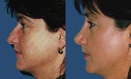 Rhinoplasty Before & After Gallery - Patient 122406683 - Image 2