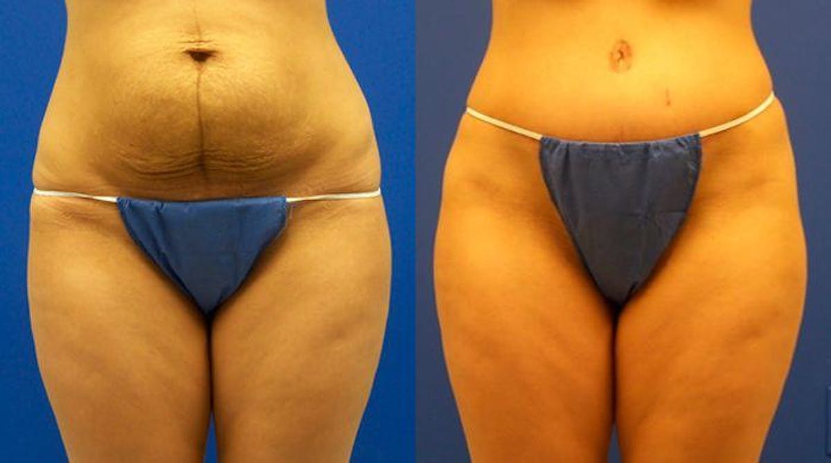 Tummy Tuck Before & After Gallery - Patient 122406684 - Image 1