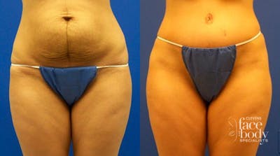 Hidden Tummy Tuck Before & After Gallery - Patient 276606 - Image 1