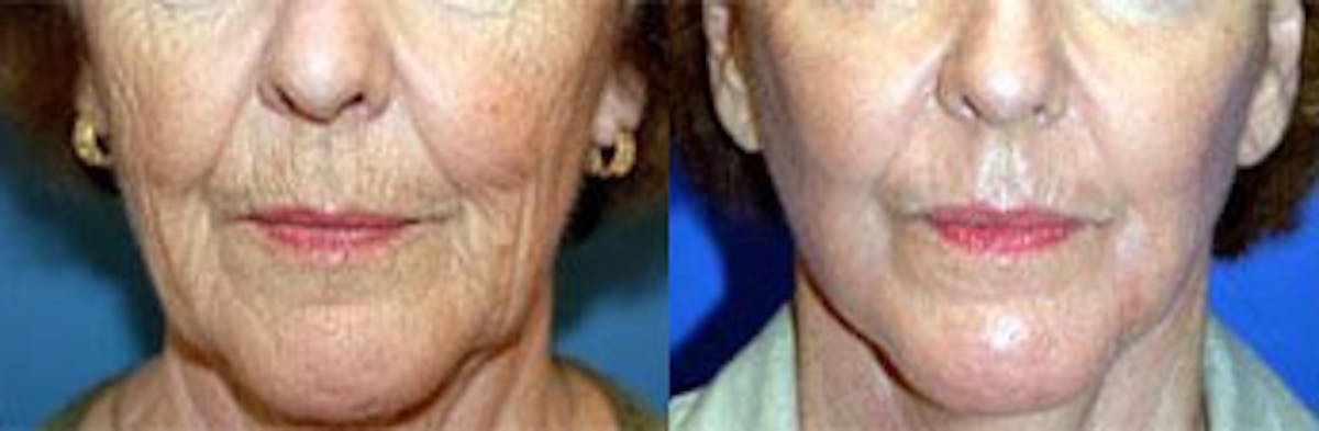 Skin Resurfacing Before & After Gallery - Patient 122406682 - Image 1