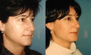 Rhinoplasty Before & After Gallery - Patient 122406683 - Image 3