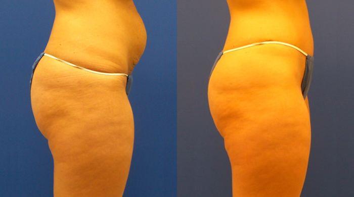 Hidden Tummy Tuck Before & After Gallery - Patient 276606 - Image 2