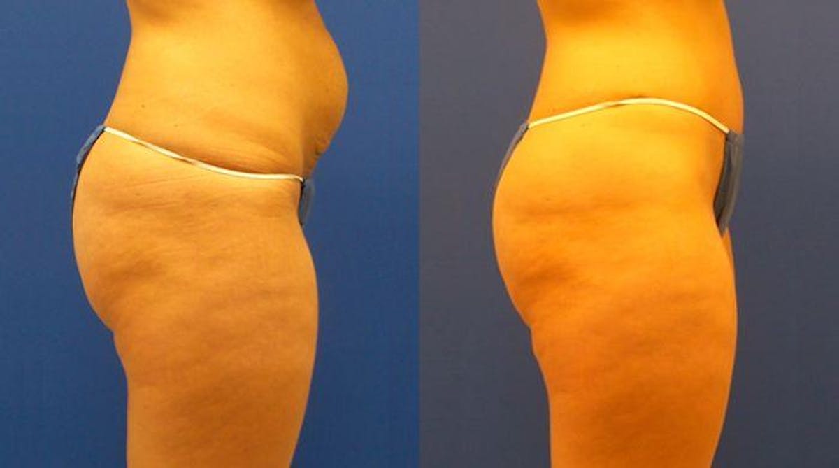 Hidden Tummy Tuck Before & After Gallery - Patient 276606 - Image 2