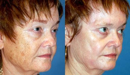 Skin Resurfacing Before & After Gallery - Patient 122406685 - Image 1