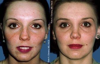 Rhinoplasty Before & After Gallery - Patient 122406687 - Image 1