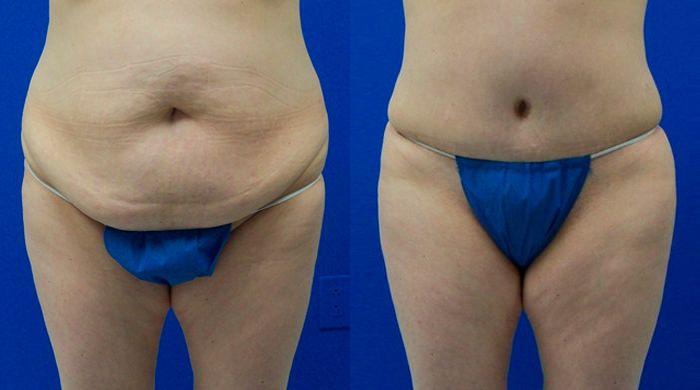 Hidden Tummy Tuck Before & After Gallery - Patient 100602 - Image 1