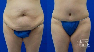 Hidden Tummy Tuck Before & After Gallery - Patient 100602 - Image 1