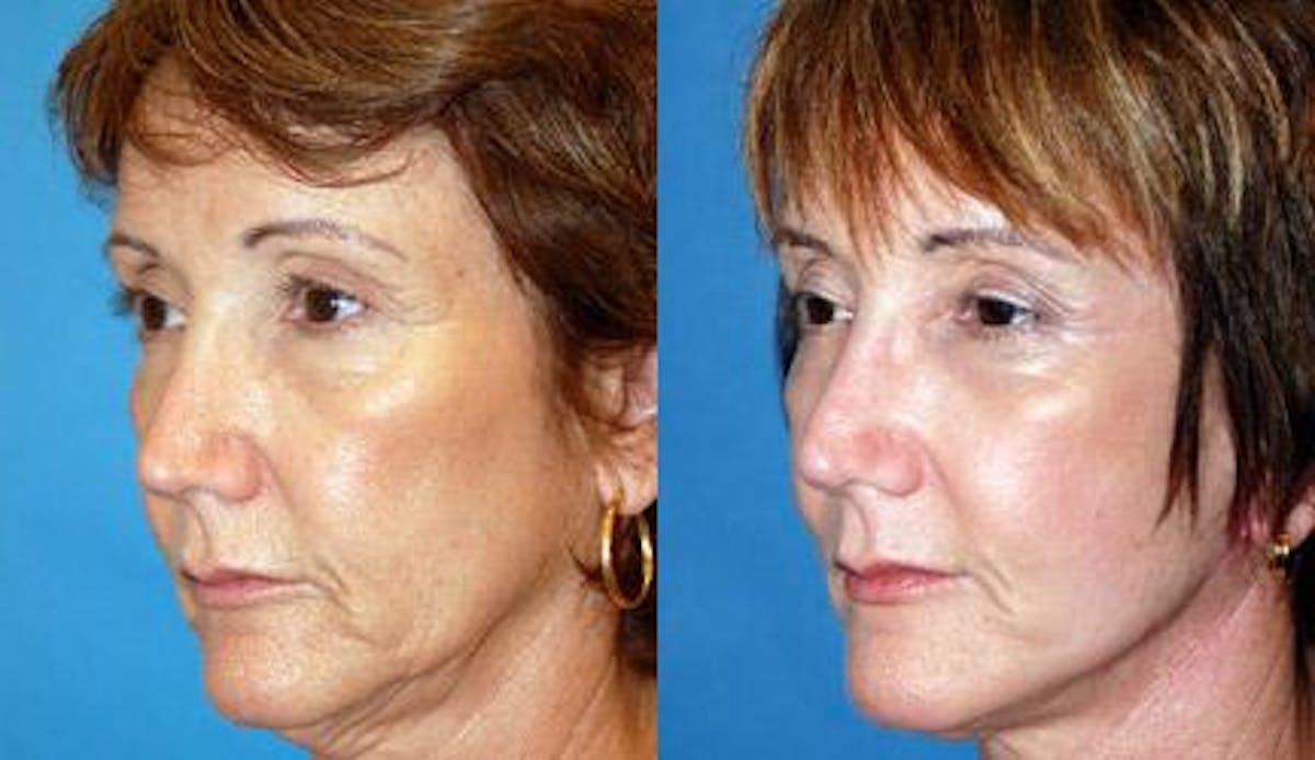 Skin Resurfacing Before & After Gallery - Patient 122406686 - Image 1
