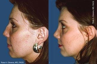 Rhinoplasty Before & After Gallery - Patient 122406687 - Image 2