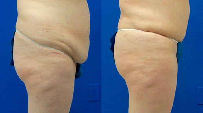 Hidden Tummy Tuck Before & After Gallery - Patient 100602 - Image 2