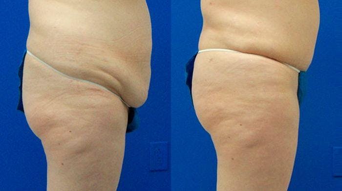 Tummy Tuck Before & After Gallery - Patient 122406688 - Image 2