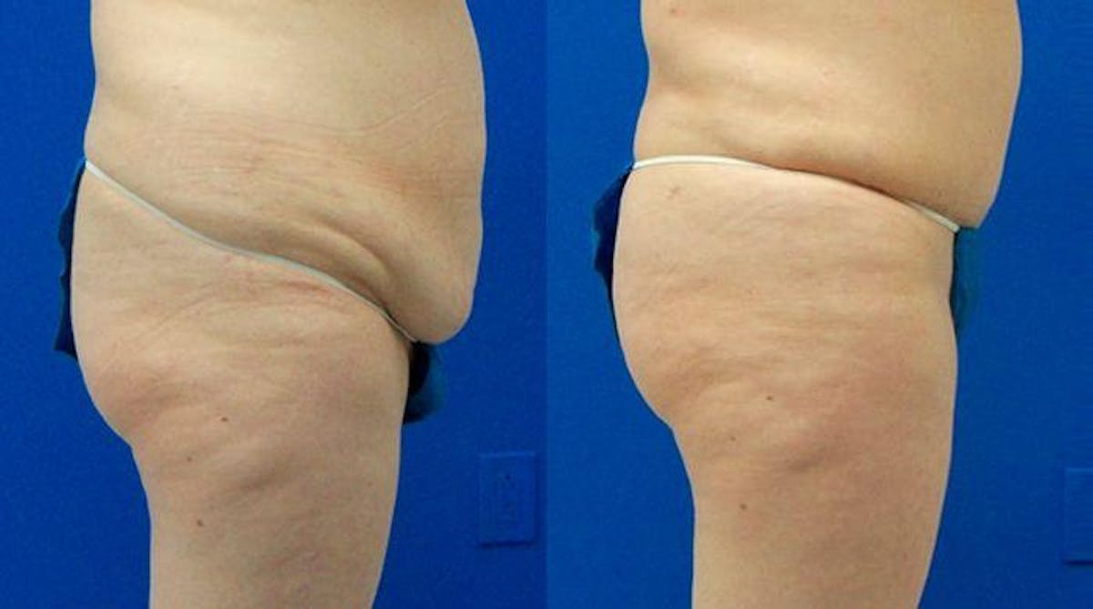 Tummy Tuck Before & After Gallery - Patient 114784 - Image 2