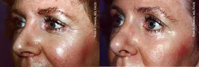 Skin Resurfacing Before & After Gallery - Patient 122406689 - Image 1