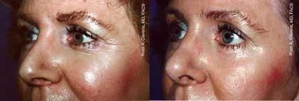 Skin Resurfacing Before & After Gallery - Patient 122406689 - Image 1
