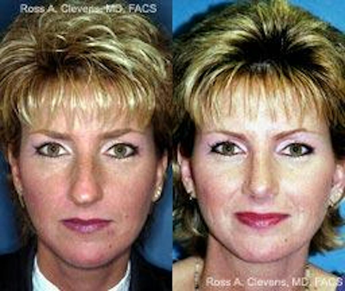 Rhinoplasty Before & After Gallery - Patient 122406691 - Image 1
