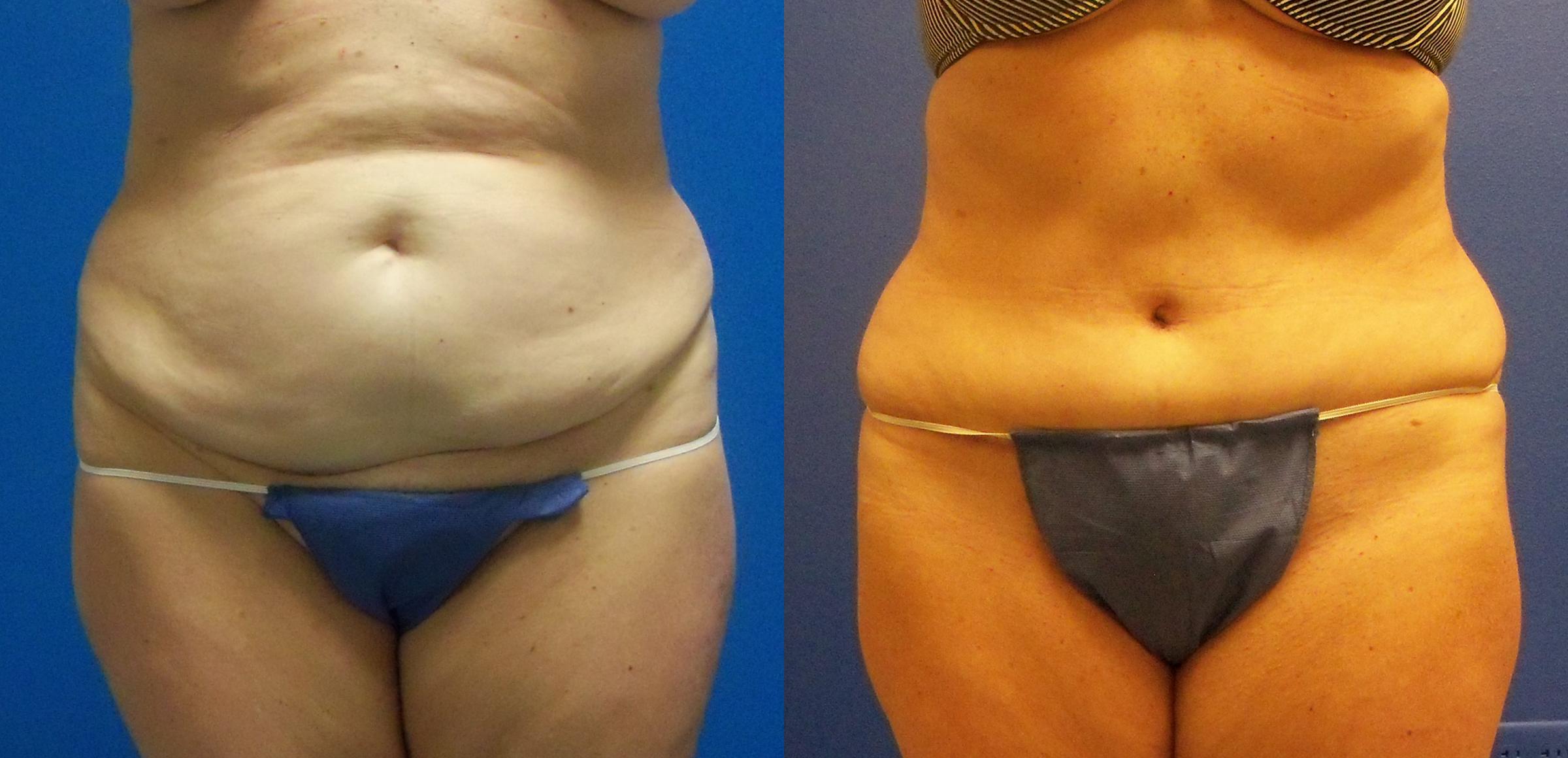 Hidden Tummy Tuck Before & After Gallery - Patient 201582 - Image 1