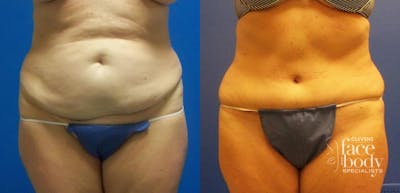 Hidden Tummy Tuck Before & After Gallery - Patient 201582 - Image 1