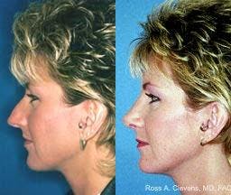 Rhinoplasty Before & After Gallery - Patient 122406691 - Image 2