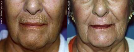 Skin Resurfacing Before & After Gallery - Patient 122406690 - Image 1