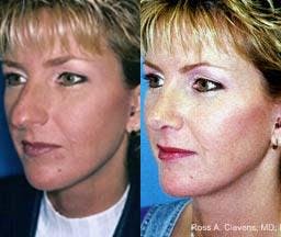 Rhinoplasty Before & After Gallery - Patient 122406691 - Image 3