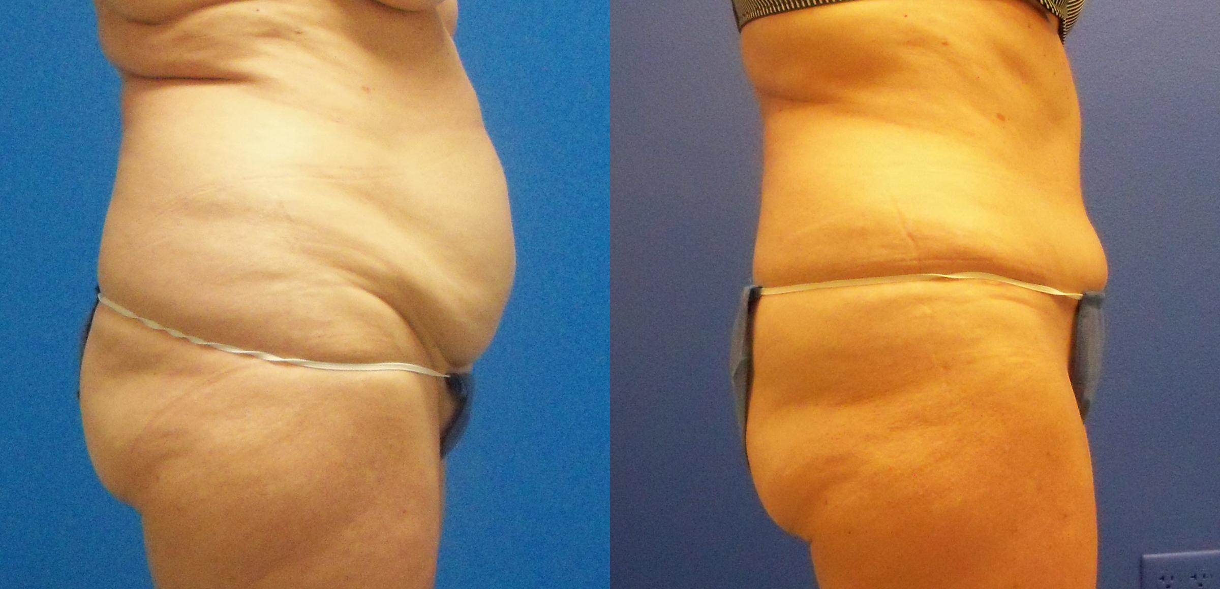 Hidden Tummy Tuck Before & After Gallery - Patient 201582 - Image 2