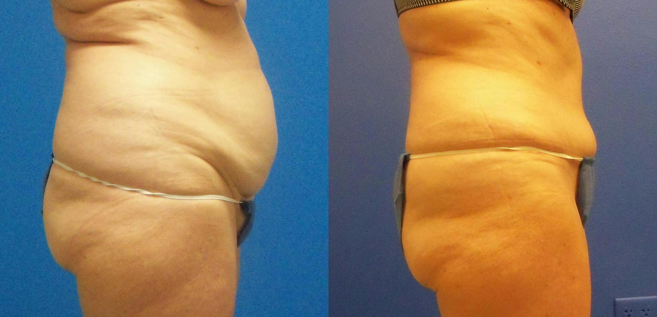 Tummy Tuck Before & After Gallery - Patient 122406696 - Image 2