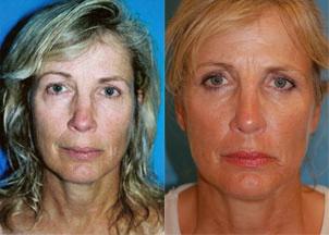 Skin Resurfacing Before & After Gallery - Patient 122406692 - Image 1