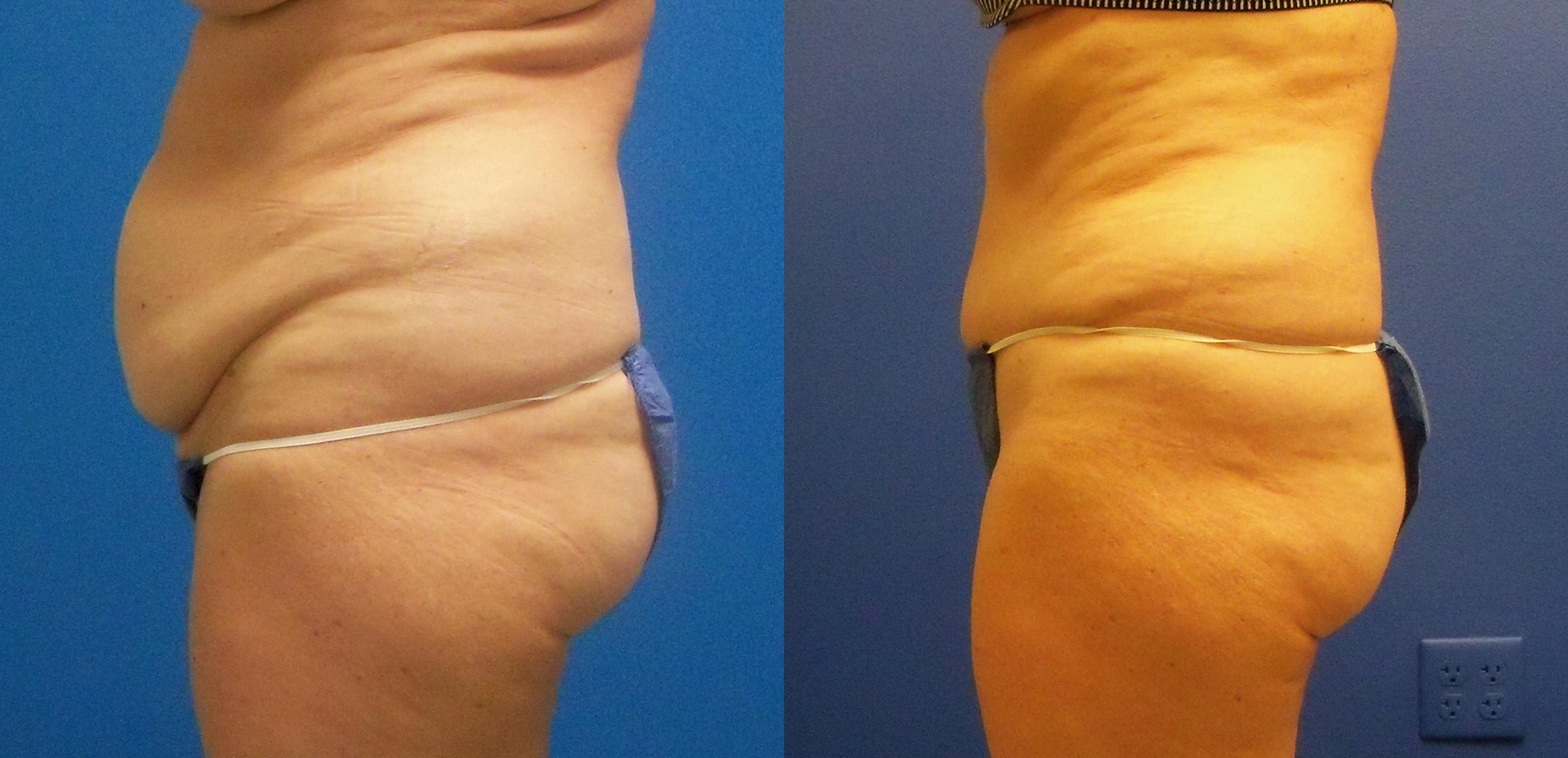 Hidden Tummy Tuck Before & After Gallery - Patient 201582 - Image 3