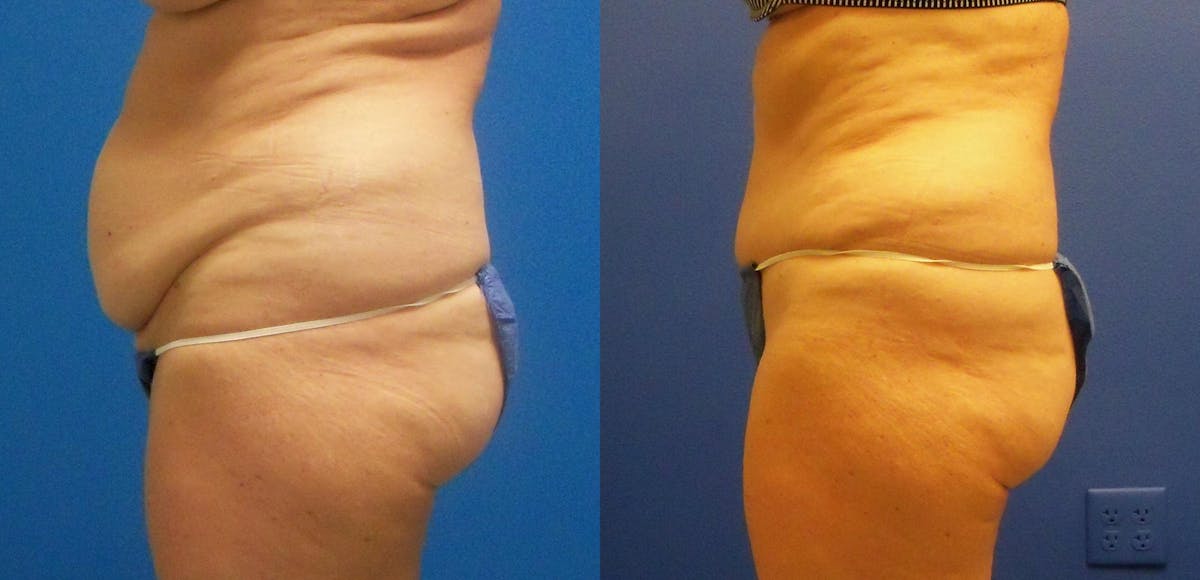 Tummy Tuck Before & After Gallery - Patient 357967 - Image 3