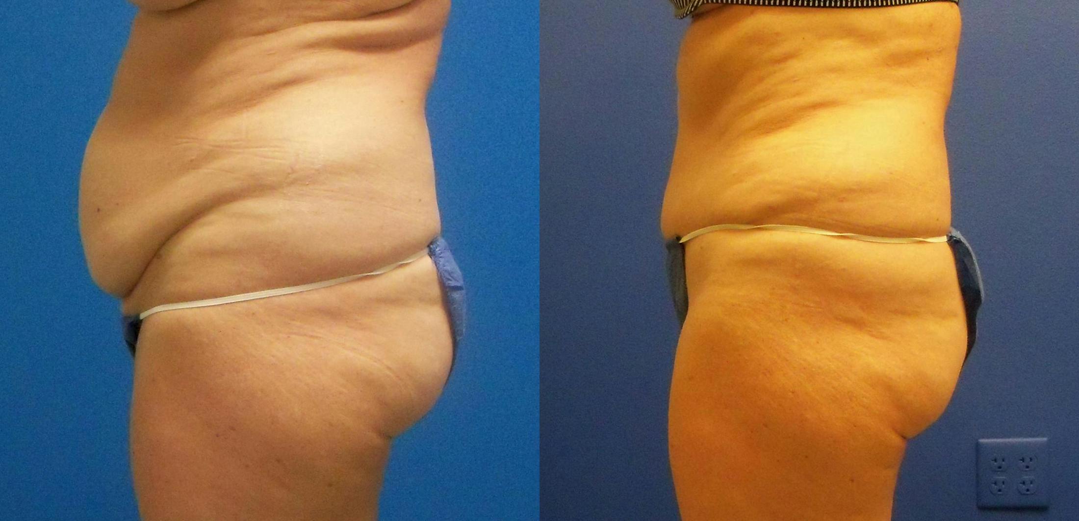 Tummy Tuck Before & After Gallery - Patient 122406696 - Image 3