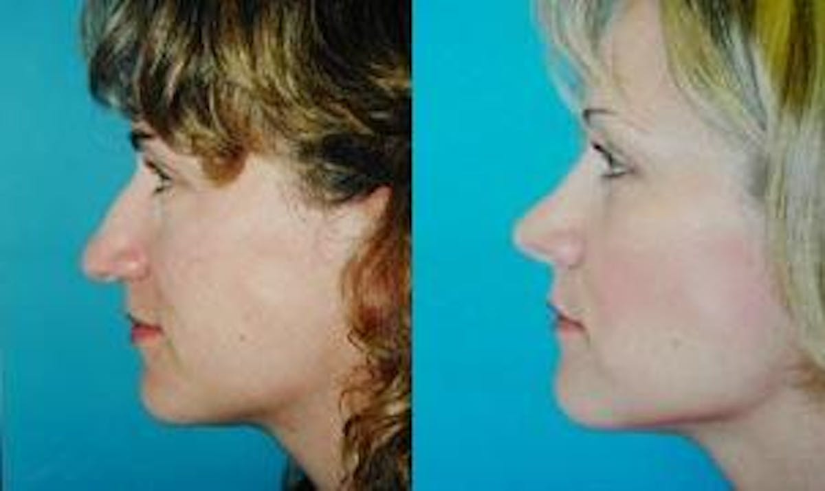 Rhinoplasty Before & After Gallery - Patient 122406693 - Image 1