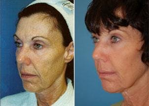 Skin Resurfacing Before & After Gallery - Patient 122406694 - Image 1