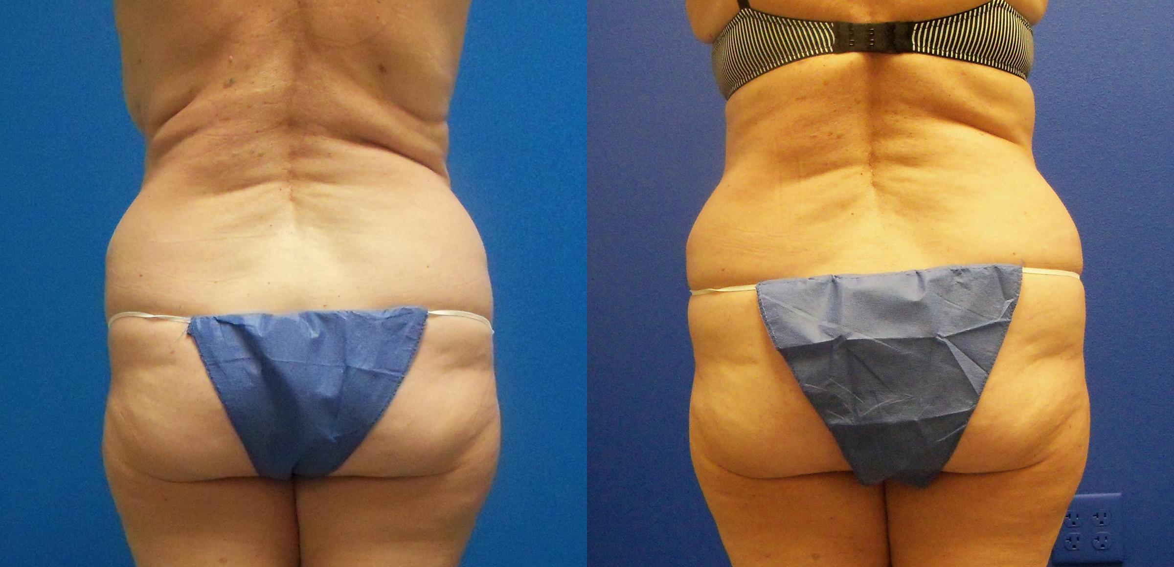 Hidden Tummy Tuck Before & After Gallery - Patient 201582 - Image 4