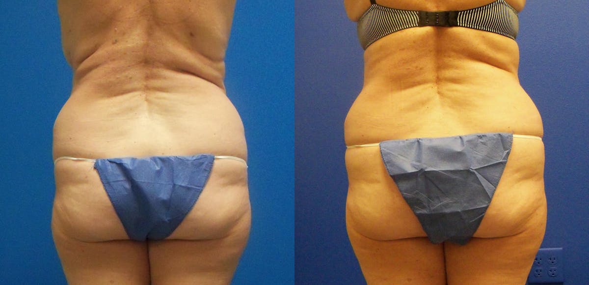 Tummy Tuck Before & After Gallery - Patient 357967 - Image 4