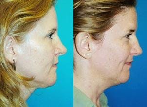 Rhinoplasty Before & After Gallery - Patient 122406695 - Image 1
