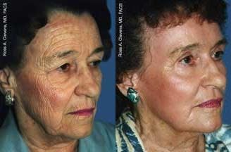 Skin Resurfacing Before & After Gallery - Patient 122406697 - Image 1