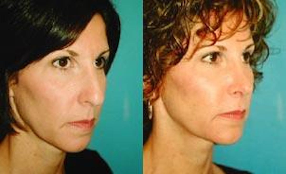 Rhinoplasty Before & After Gallery - Patient 122406702 - Image 1