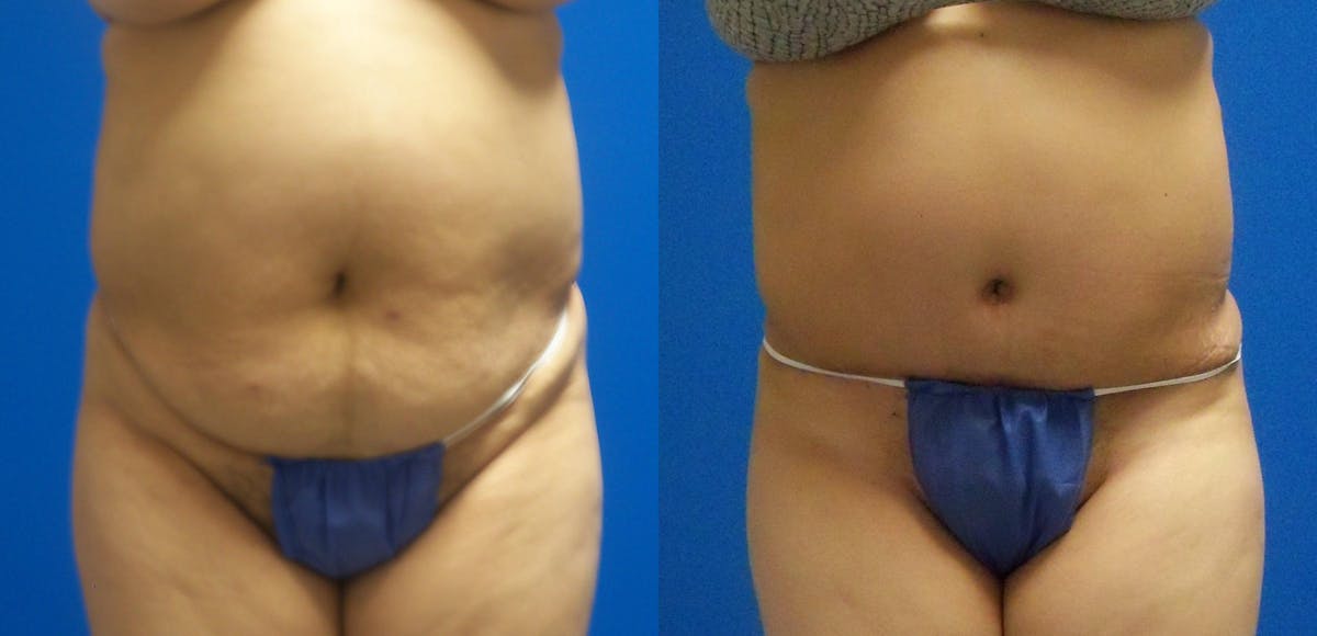 Tummy Tuck Before & After Gallery - Patient 417938 - Image 1