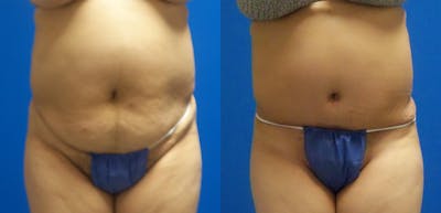 Tummy Tuck Before & After Gallery - Patient 417938 - Image 1