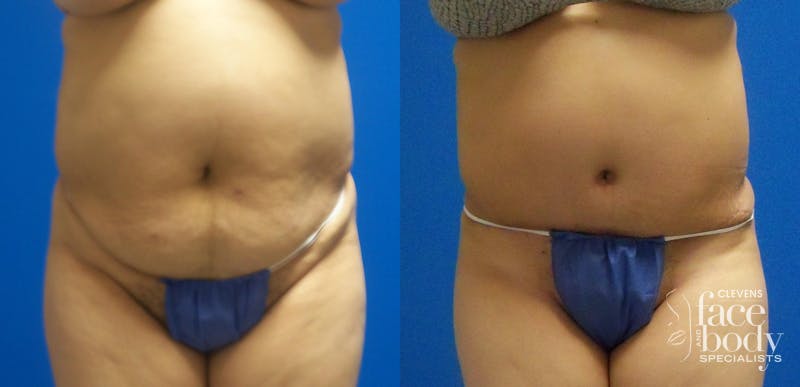 Hidden Tummy Tuck Before & After Gallery - Patient 229942 - Image 1