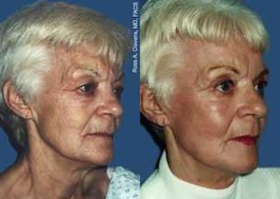 Skin Resurfacing Before & After Gallery - Patient 122406701 - Image 1