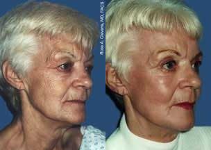Skin Resurfacing Before & After Gallery - Patient 122406701 - Image 1