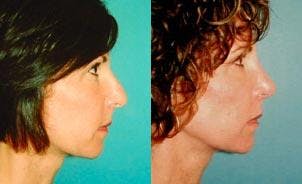 Rhinoplasty Before & After Gallery - Patient 122406702 - Image 2