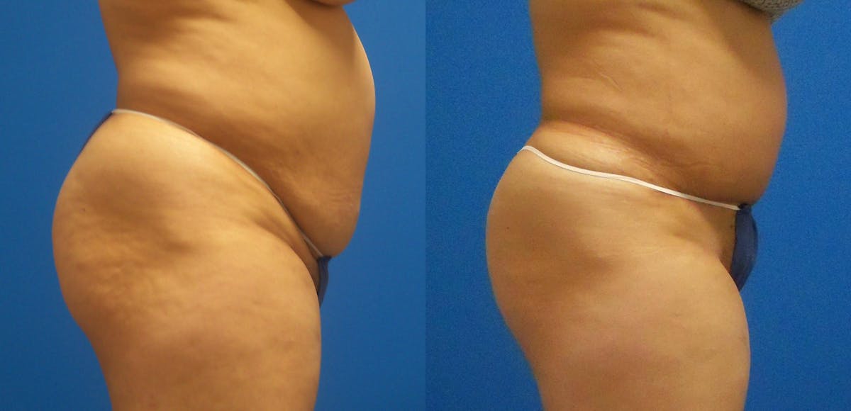 Tummy Tuck Before & After Gallery - Patient 417938 - Image 2