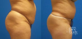 Hidden Tummy Tuck Before & After Gallery - Patient 229942 - Image 2
