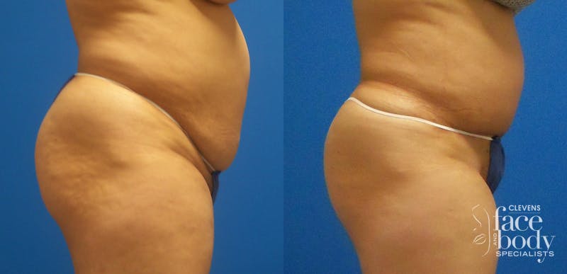 Hidden Tummy Tuck Before & After Gallery - Patient 229942 - Image 2